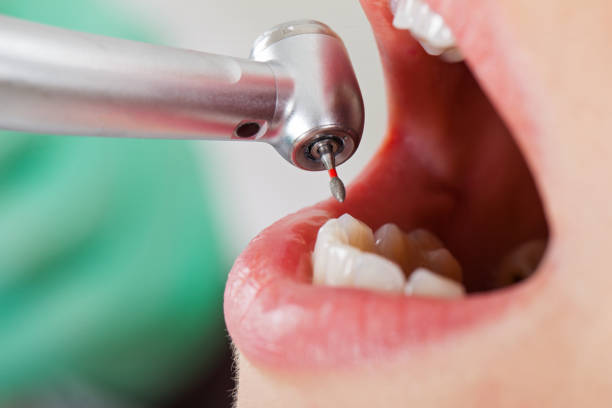Best Emergency Tooth Extraction in Chico, WA